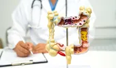 Semnal de alarmă: Creșterea alarmantă a cazurilor de cancer colorectal la tineri