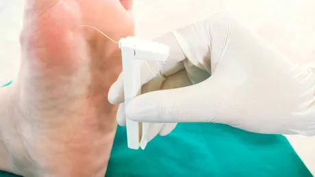 Piciorul diabetic: simptome, tratament