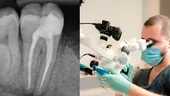 (P) Durerea de masea si tratamentul de canal: cand poate fi util microscopul dentar
