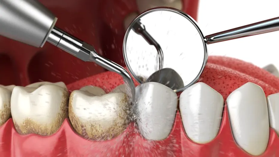 Detartrajul dentar – ce probleme apar dacă nu mergi la dentist pentru îndepărtarea tartrului