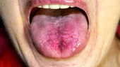 Ai limba roșie? Ce boli ascunde