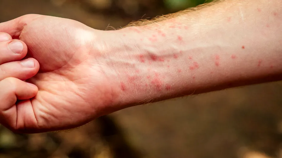 Mușcătura de țânțar: dacă ți se întâmplă ASTA înseamnă că ai luat un virus
