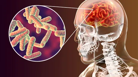 Meningita bacteriană: efecte, riscuri, simptome