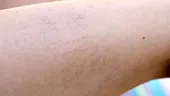 De ce NU trebuie să ignori venele sparte de pe picioare