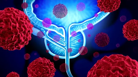 Tumorile uroteliale: cauze, simptome, tratament