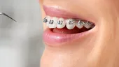 (P) 5 semne clare care indică că ai putea avea nevoie de aparat dentar