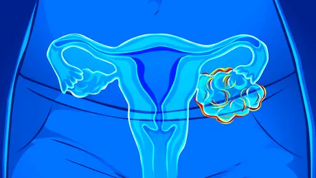 Cancerul ovarian atacă și fetele sub 18 ani! Factori de risc și primele semnale de alarmă