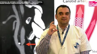 Stenoza de arteră carotidă internă – tratamentul minim invaziv prin plasare de stent carotidian