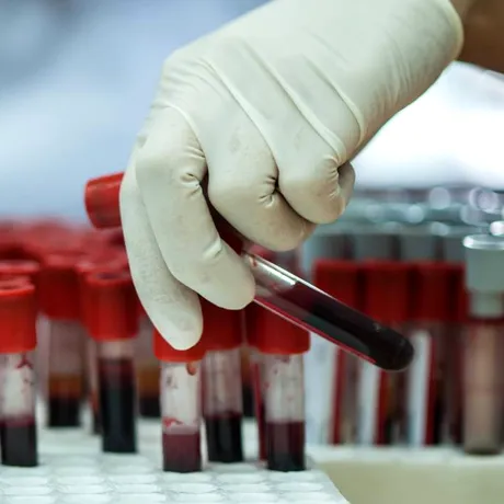 De ce nu este recomandat să îți faci analizele imediat după vacanță. Explicațiile unui medic de laborator