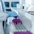 Poate fi depistat cancerul printr-o simplă analiză de sânge?