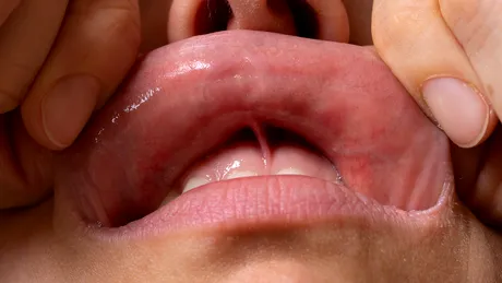 Semnul care apare pe buză la bătrânețe și crește riscul de demență. La ce să fii atent