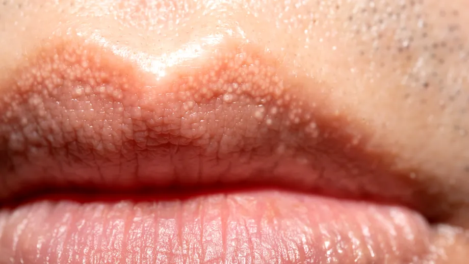 Punctele albe pe buze, penis sau labii nu înseamnă herpes! De ce apar și cum se tratează