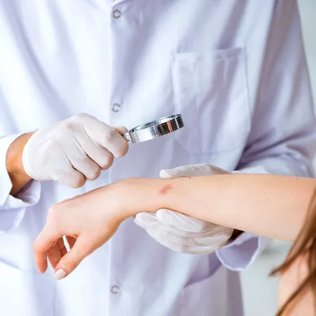 Ectima: de ce apare și cum o tratezi