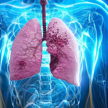 De ce cancerul poate reveni după ani de zile. Cum poate fi prevenită recidiva