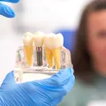 (P) Cum afecteaza diabetul succesul implanturilor dentare