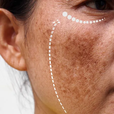 Cum îmbătrânește pielea. La 20 de ani se formează primele riduri, la 30-40 de ani apar petele pigmentare cauzate de soare