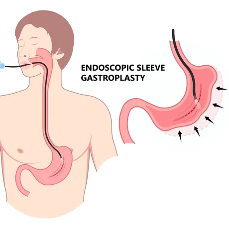 ESG (micșorarea de stomac pe cale endoscopică): alternativa endoscopică pentru slăbire, fără operații invazive