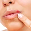 Simți că îți apare herpes? Ce să faci imediat ca să nu erupă