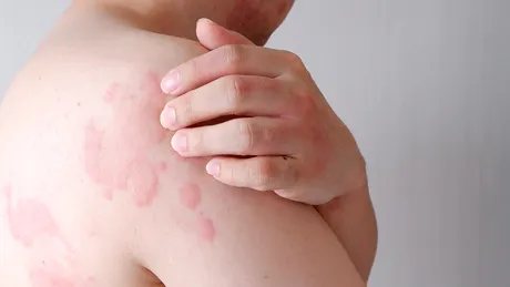 Alimentul care previne alergiile cutanate. Ideal să fie mâncat crud