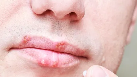 Infecţia orofacială cu virusurile HSV: cauze, simptome, tratament