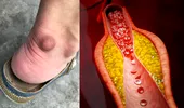 Ai observat aceste schimbări la ochi sau picioare? Pot avea legătură cu colesterolul