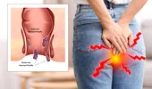 Ce să mănânci pentru a reduce riscul de cancer colorectal. Alimentele recomandate la micul dejun, prânz și cină și ce ar trebui să eviți