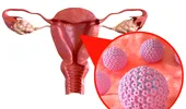 Legătura dintre HPV și fertilitate. Impactul infecției cu HPV asupra fertilității