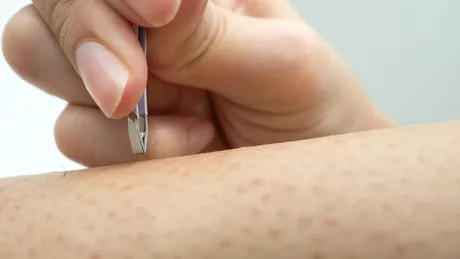 Tot ce trebuie să știi despre firele de păr crescute sub piele