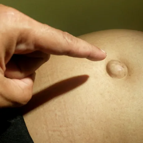 Semnul vizibil pe abdomen care poate trăda o hernie. La început poate să nu doară deloc