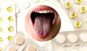 Medicamente care usucă gura, pătează dinții și ne lasă cu un gust metalic