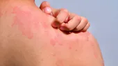 Urticaria: ce o declanșează și cum o ții sub control cu remedii naturiste