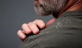 (P) Mătreață și seleniu: beneficii pentru microbiomul scalpului