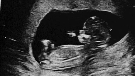 Fenomenul rar al „bebeluşului de piatră”. Rămâne asimptomatic în corp timp de până la 60 de ani. „Fătul mort se află în abdomen și devine calcificat pentru a proteja mama de infecție”