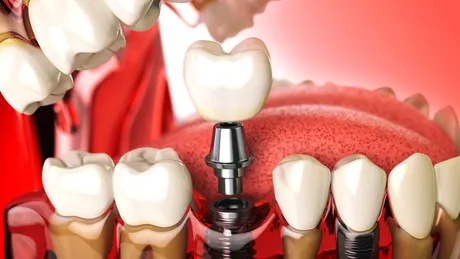 Ce trebuie să știe pacientul care a pierdut mai mulți dinți și are nevoie de tratament cu implanturi dentare și adiție de os