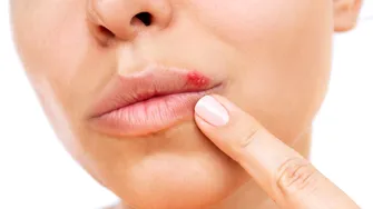 Cum să scapi de herpes repede. Remediul natural care îl face să dispară peste noapte
