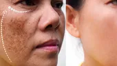 Scapă de petele pigmentare cu o mască naturală din trei ingrediente. Secretul unui ten de porțelan