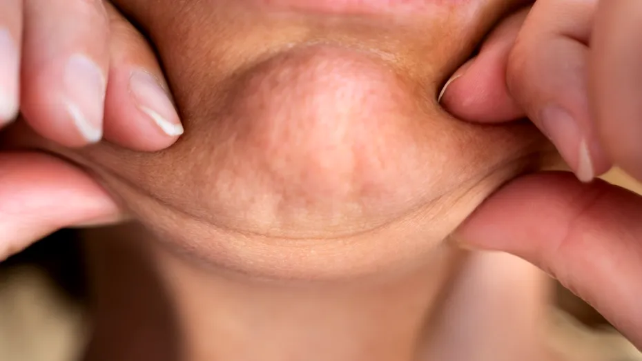 De ce facem gușă? 3 cauze mai puțin cunoscute ale bărbiei duble