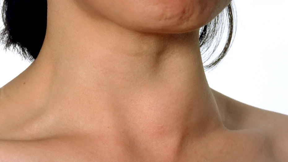 Semnele unui nodul tiroidian. Cine e la risc și când e nevoie de operație