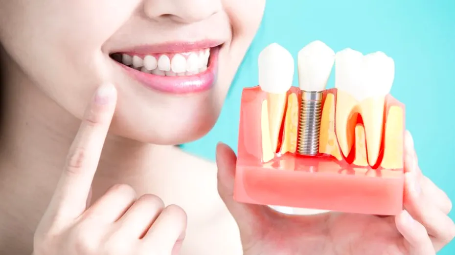 Implant dentar digital – tot ce trebuie să știi despre acesta