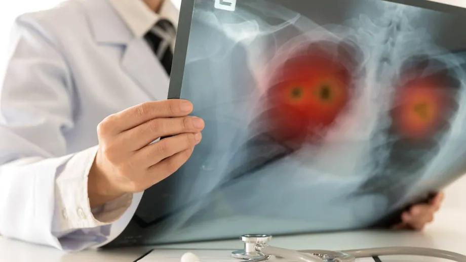 De ce foștii fumători rămân vulnerabili la bolile pulmonare. Ce se întâmplă în plămâni după ce renunți la țigări