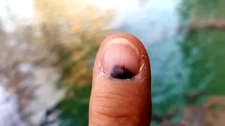Cancerul pe care-l poți vedea pe unghie. 5 semne după care să te uiți