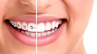 13 mituri despre aparatul dentar! cu Dr. Catrinel Banu, medic dentist specialist