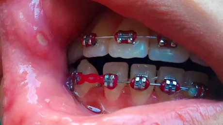 Aftele bucale, cauzate și de aparatele dentare. De ce apar, cum se manifestă și în ce constă tratamentul