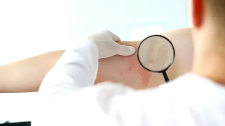 Cazuri de lepră în România! Cum se manifestă şi cum se tratează boala