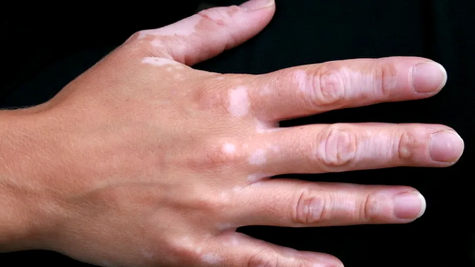 Primul tratament cu adevărat eficient împotriva vitiligo