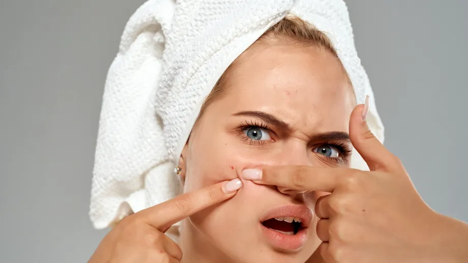 Ai puncte albe pe față? Iată ce sunt și de ce NU trebuie să le storci