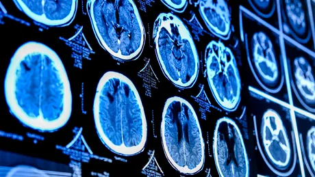 A ajuns la spital cu migrene puternice, dar medicii au avut un șoc când au descoperit ce avea bărbatul în creier. Ar fi consumat carne de porc