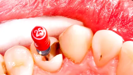 Scoaterea nervului dentar - de ce este indicată, chiar dacă nu te doare nimic?