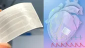 Plasturele revoluționar din grafen care se lipește pe inimă și corectează aritmiile cardiace