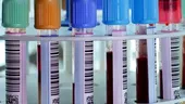 Un simplu test al sângelui ar putea diagnostica în curând 5 tipuri de cancer
